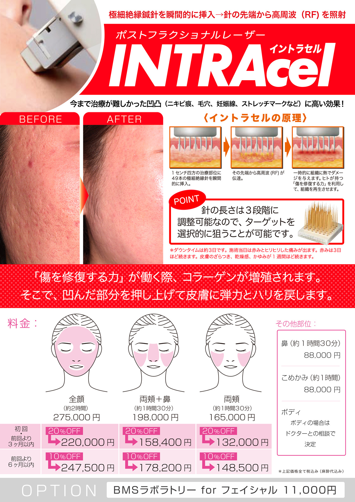 Intracel イントラセル