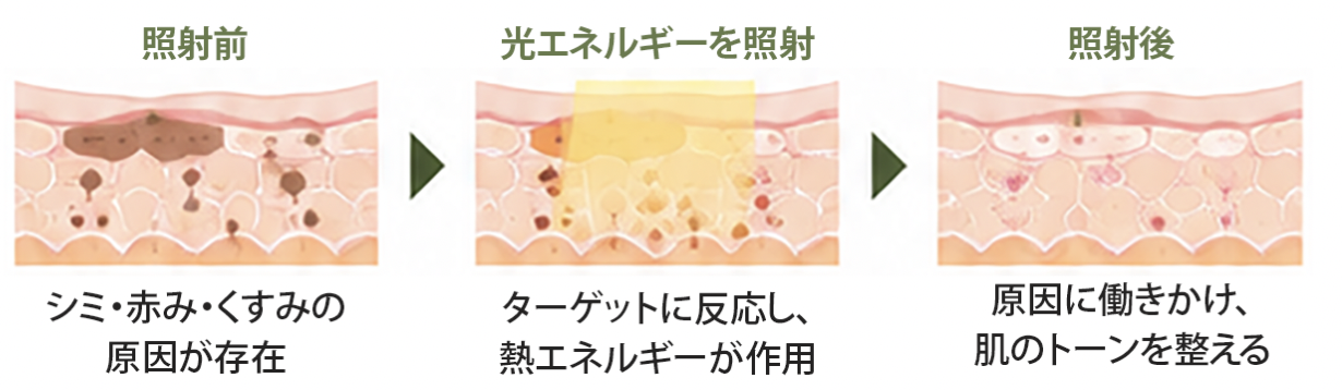 ライムライトの仕組みと効果