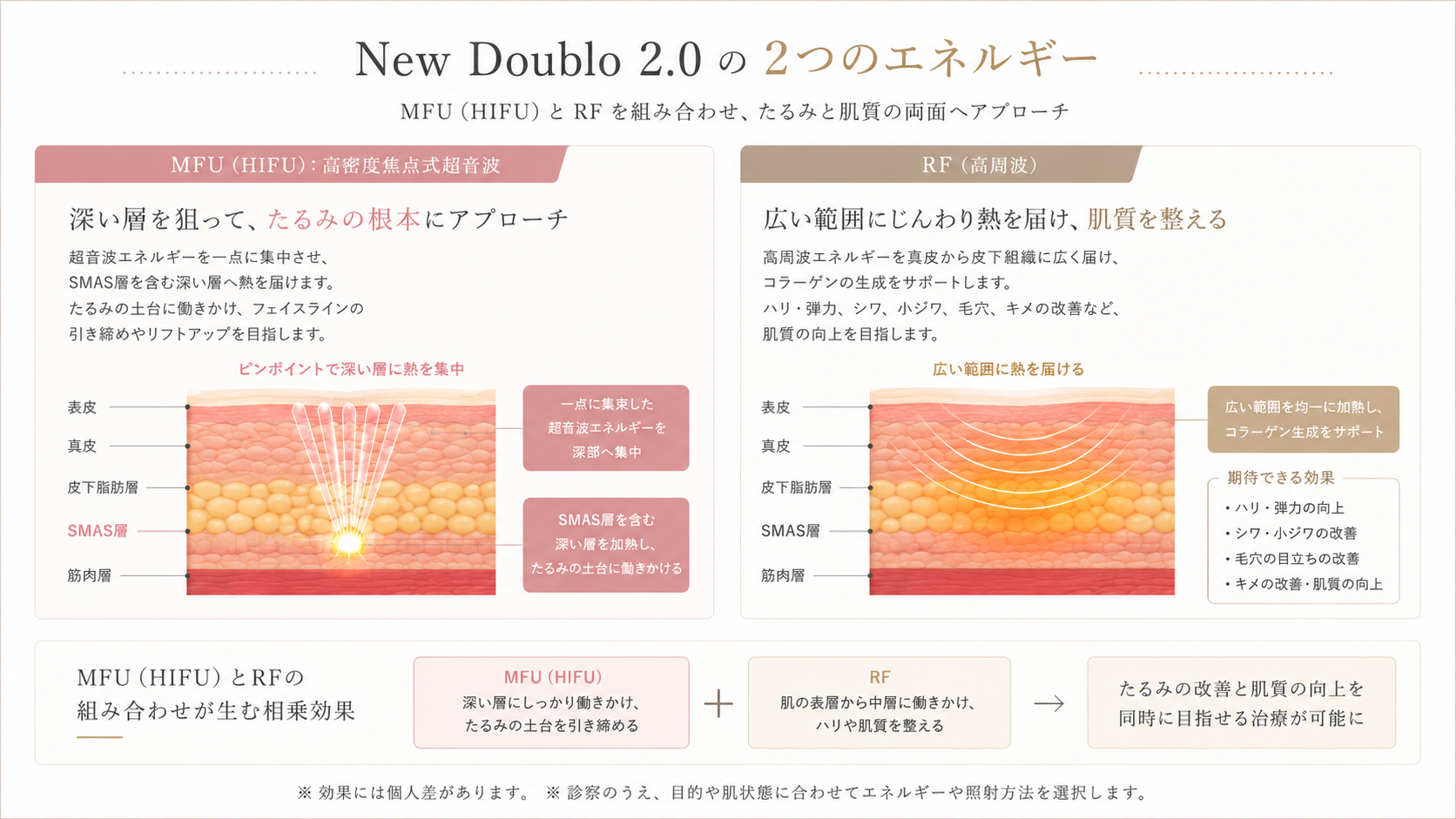 New Doublo 2.0のMFUとRFを説明する当院オリジナルイメージ　推奨サイズ1600×900px
